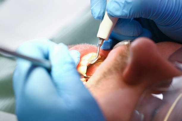 Best Emergency Root Canal Treatment in USA